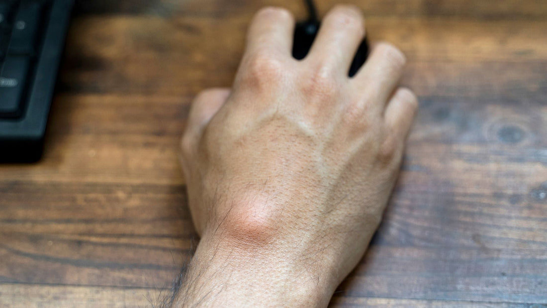 Ganglion Cysts: Harmless or a Sign to Worry?