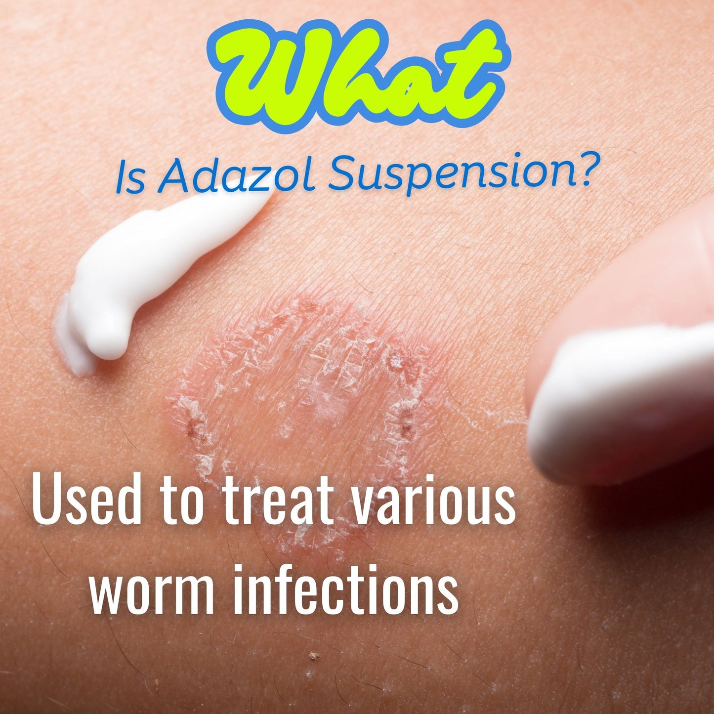 Adazol Suspension 10ml,  Treat parasitic worm infections (FAST DELIVERY)